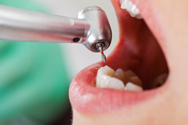 Best Emergency Tooth Extraction in Ivanhoe, CA